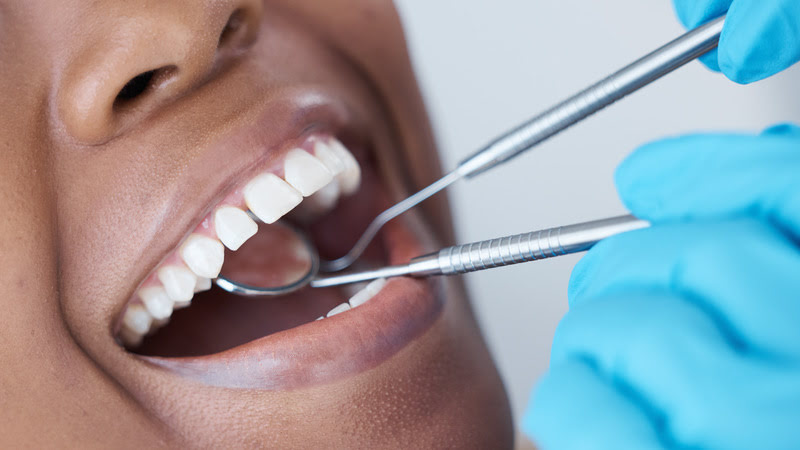 Wizyta profilaktyczna w gabinecie dentystycznym z zębami po bondingu.